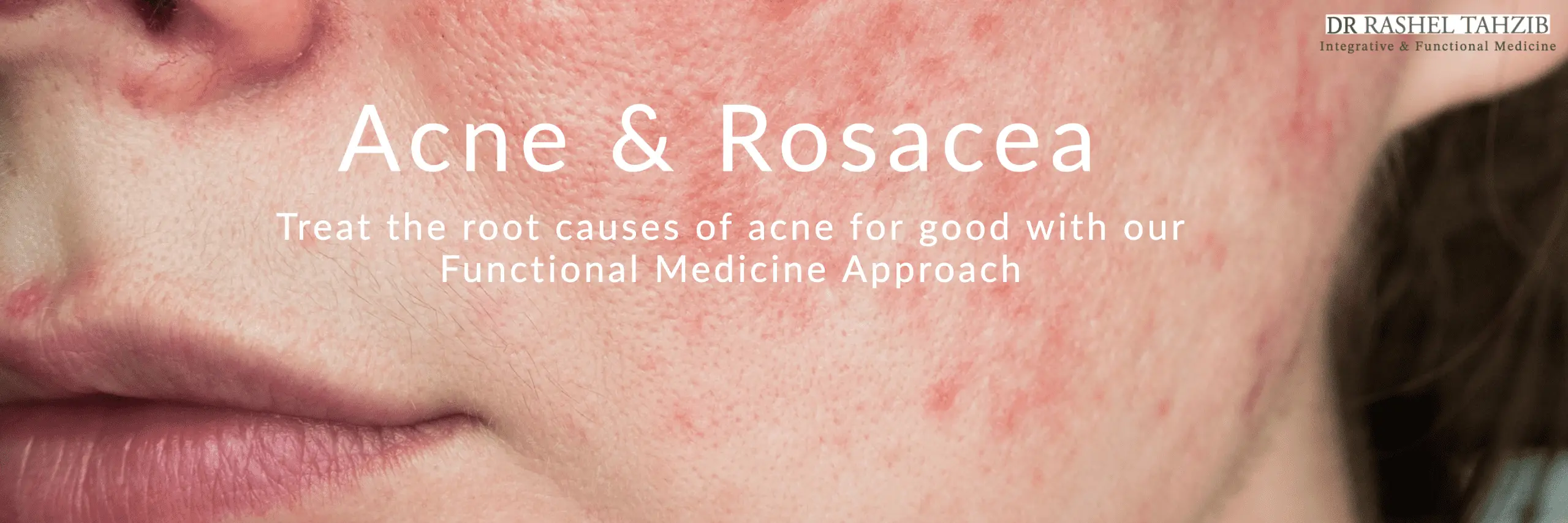 Acne and rosacea.